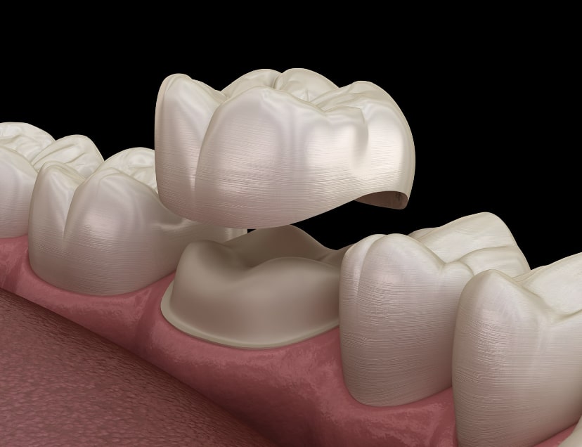 Korony Cyrkonowe i Most Dentystyczny