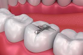 Wypełnienia Zębów (Dental Filling)