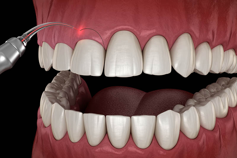Korekcja Dziąseł (Gum Contouring)