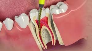 Leczenie Kanałowe (Root Canal)