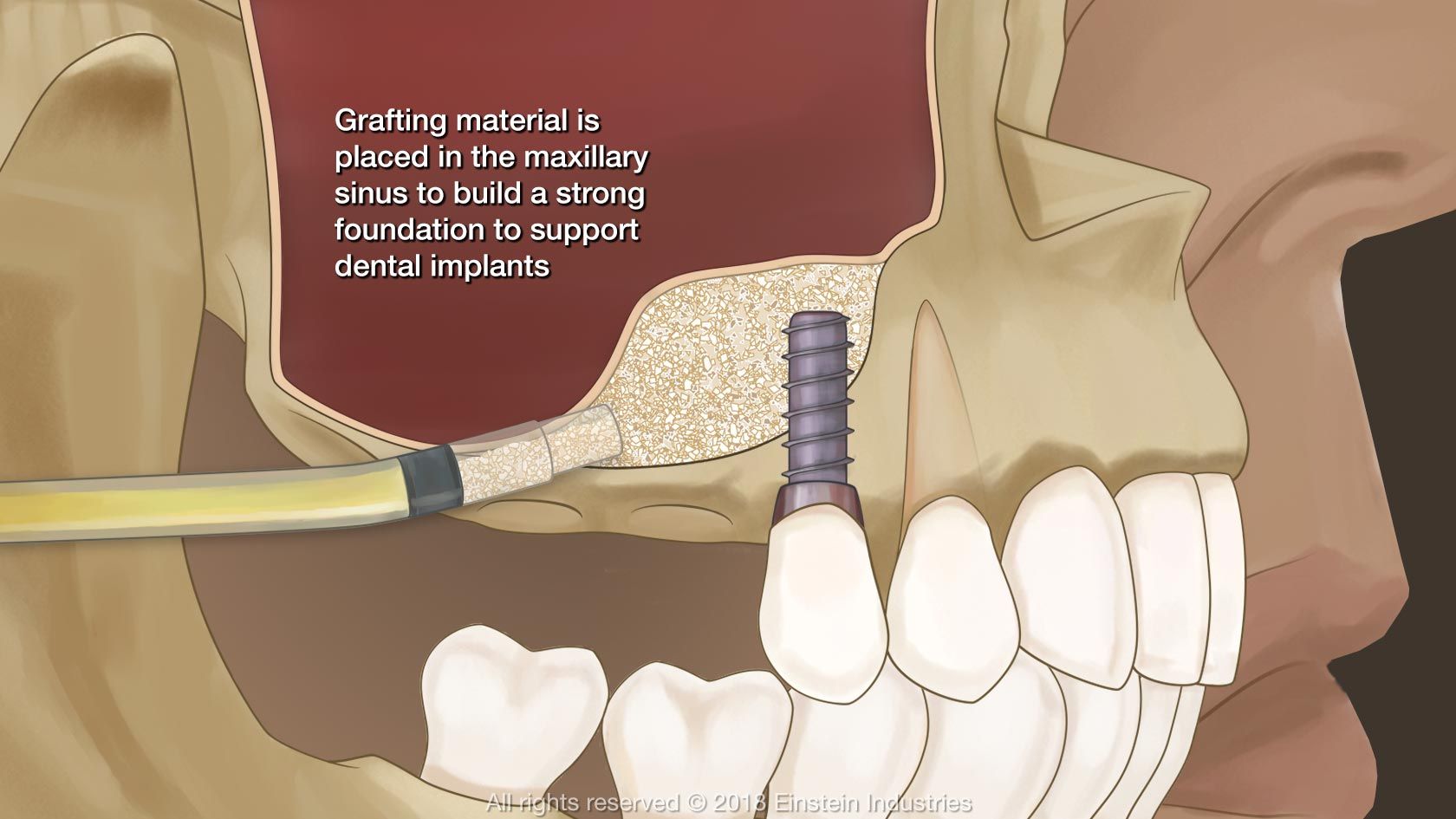 Sinus Lifting – Operacja Zatoki Szczękowej