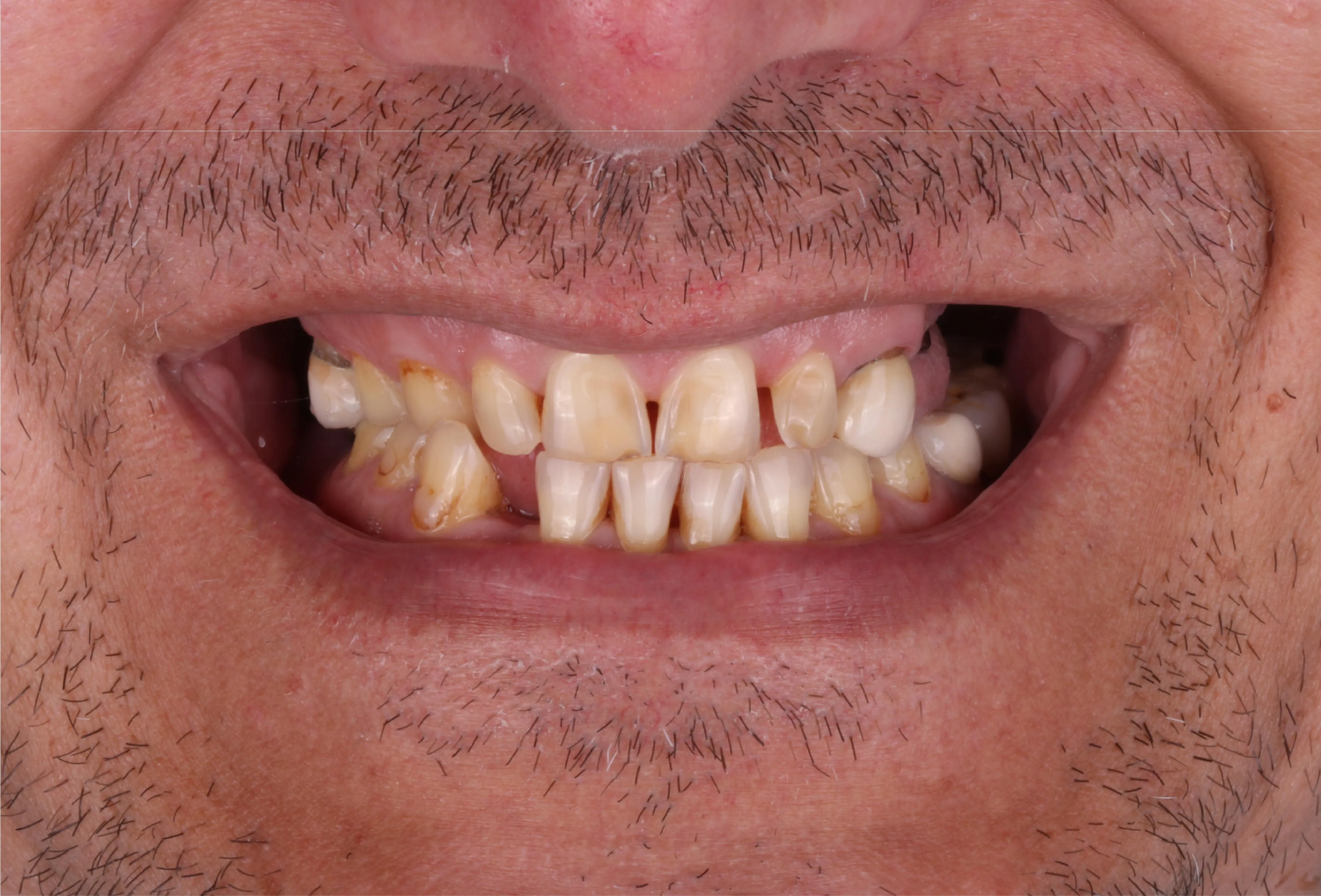 Przed implantami – Side Dental Centre