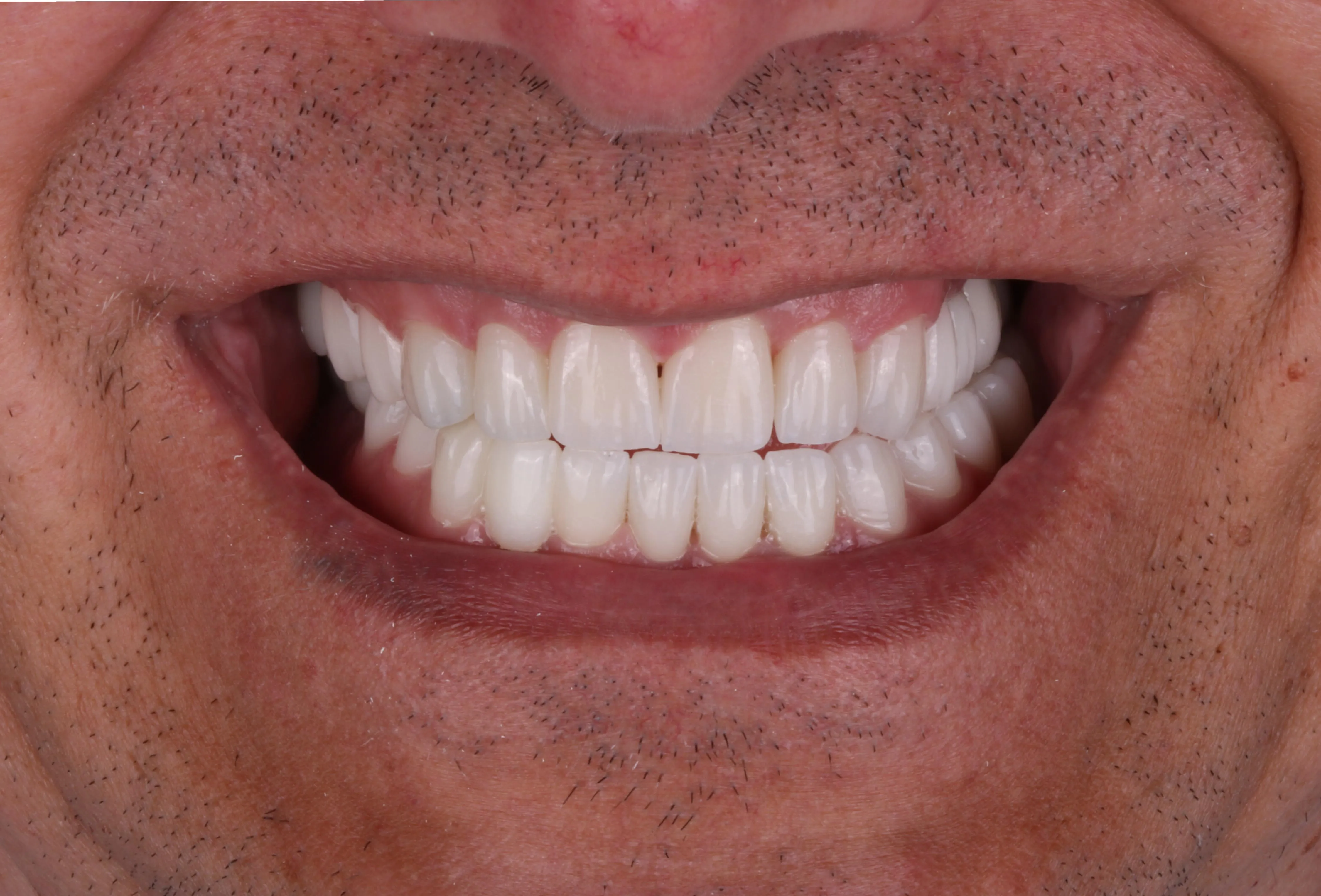 Po implantach – Side Dental Centre