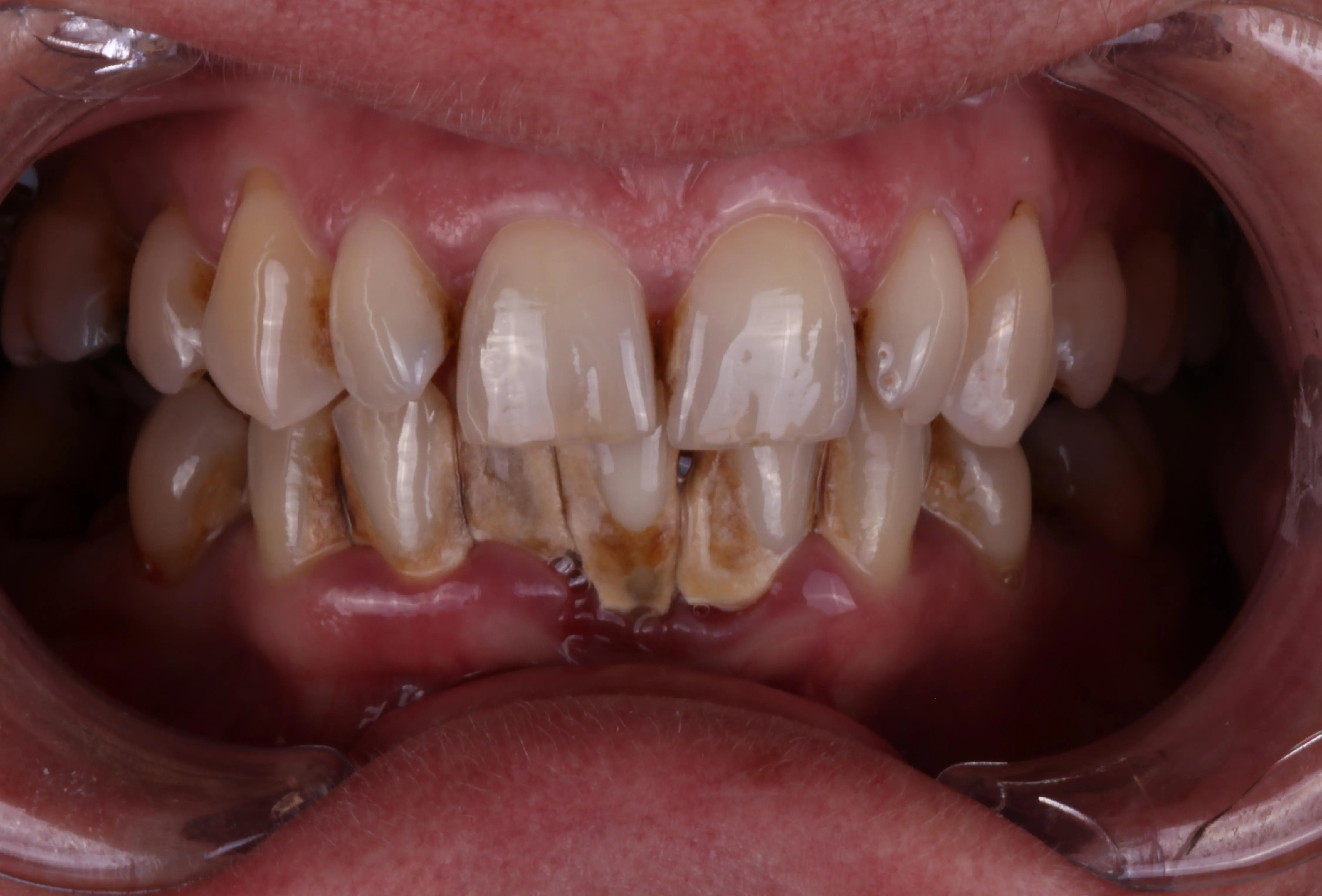 Przed leczeniem – Side Dental Centre
