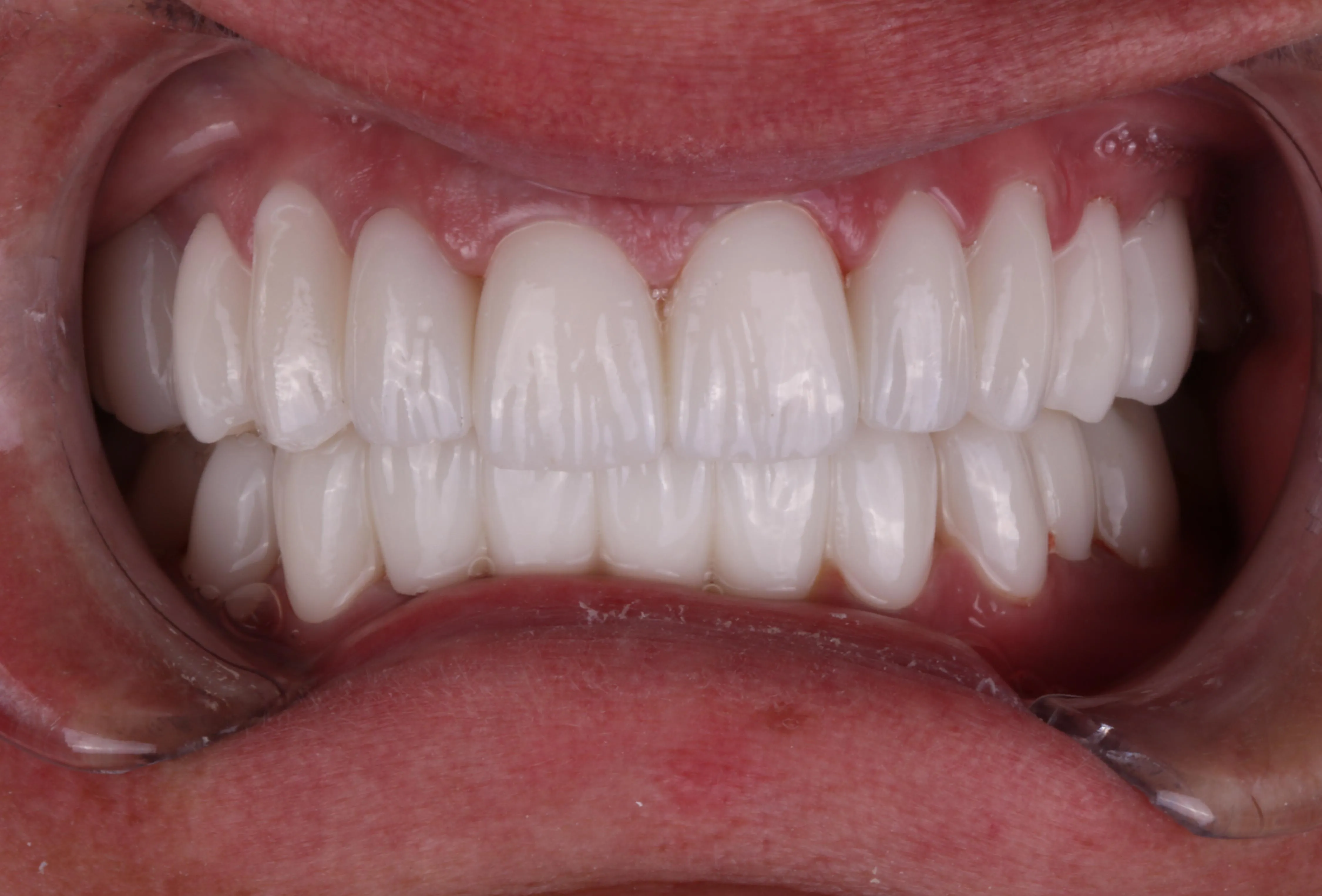 Po leczeniu – Side Dental Centre