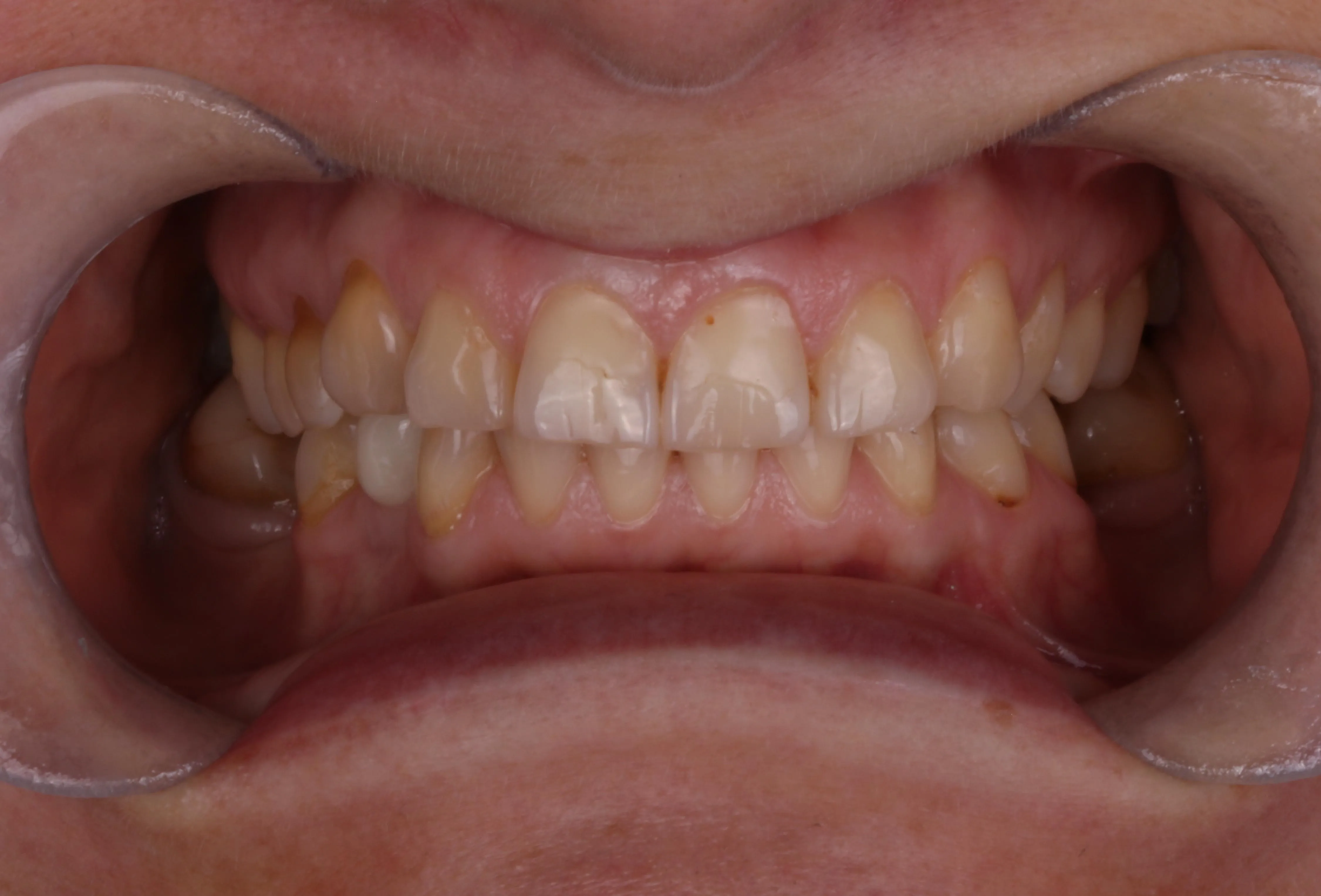 Przed zabiegiem – Side Dental Centre