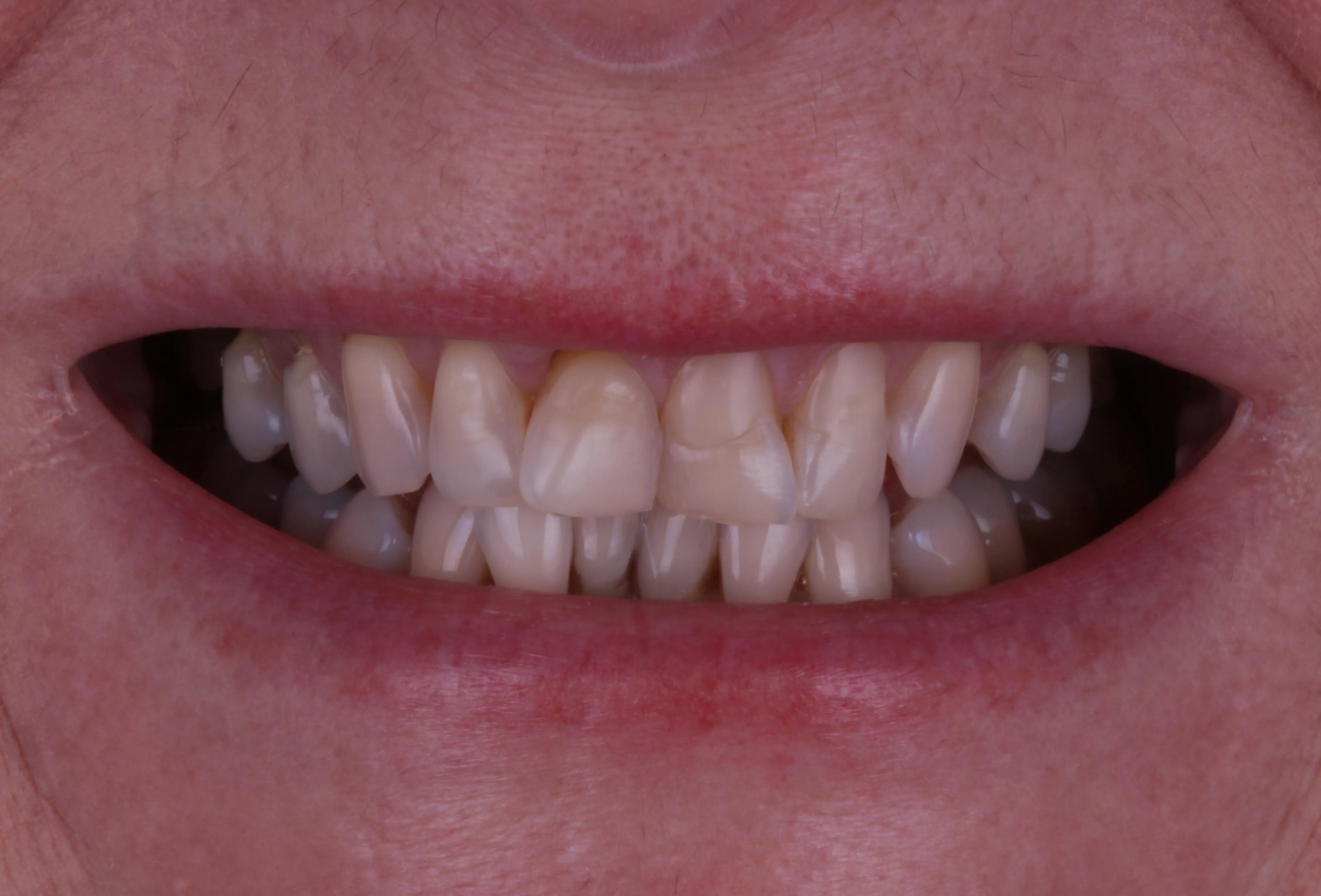 Przed Hollywood Smile – Side Dental Centre