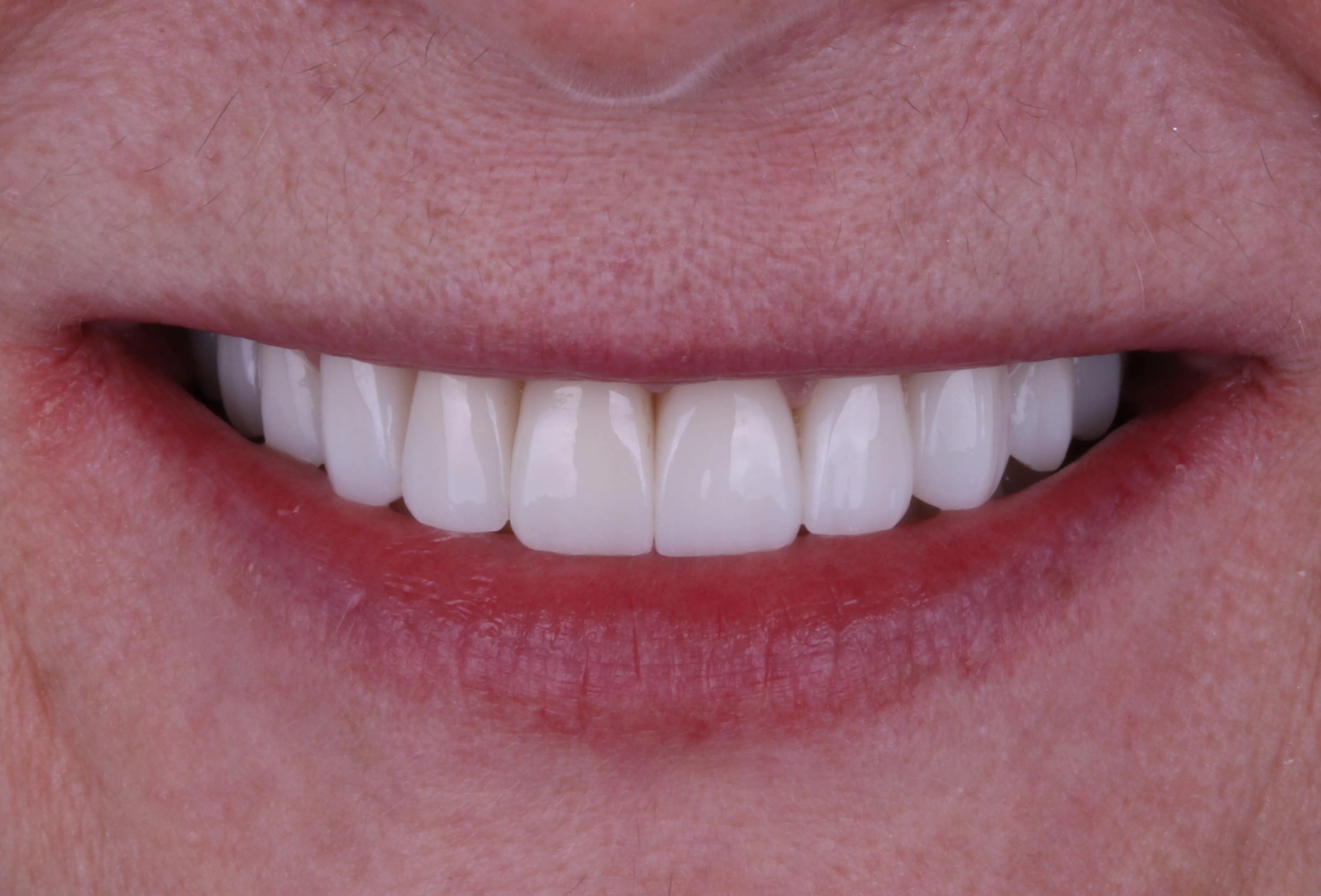 Po Hollywood Smile – Side Dental Centre