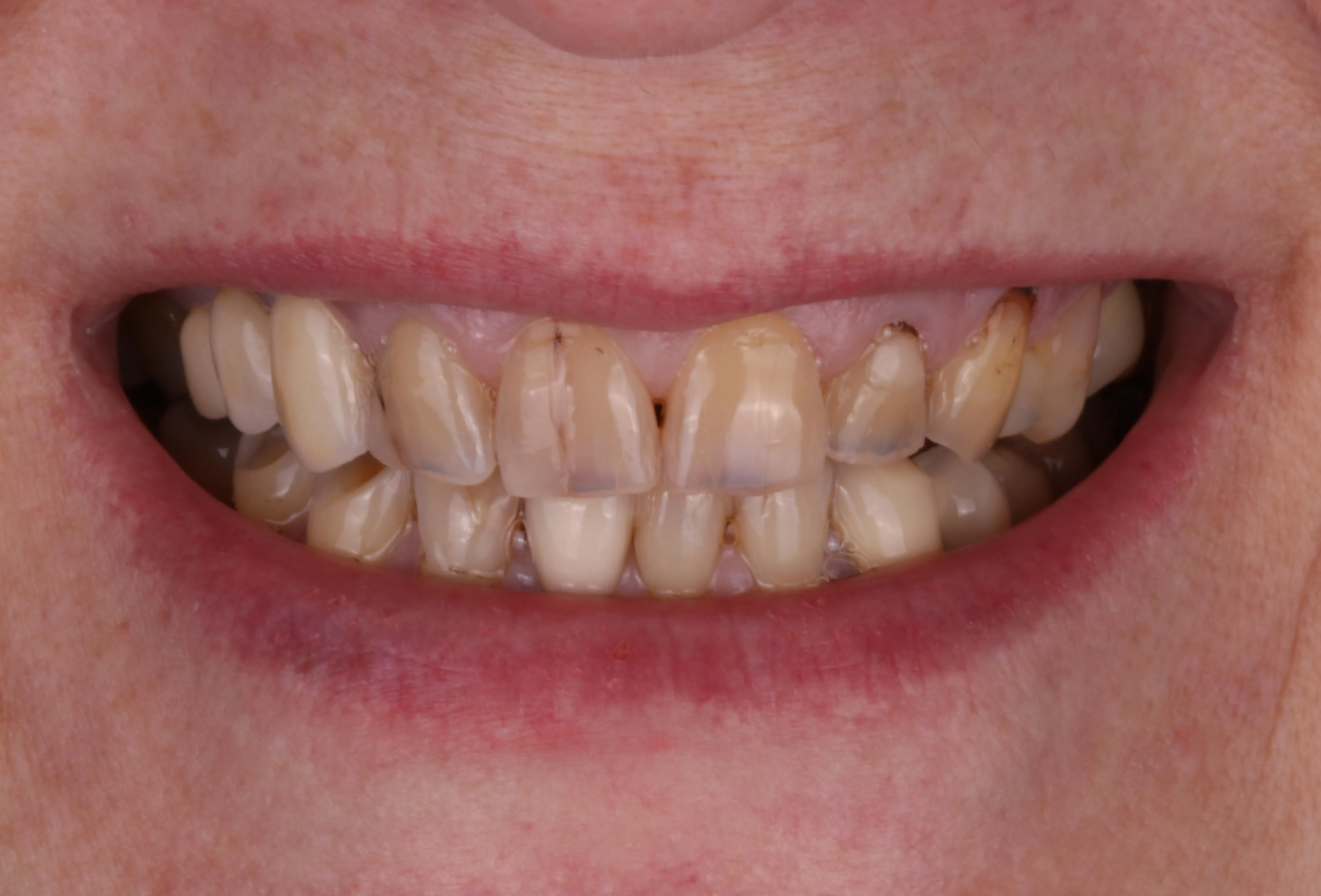 Przed licówkami – Side Dental Centre
