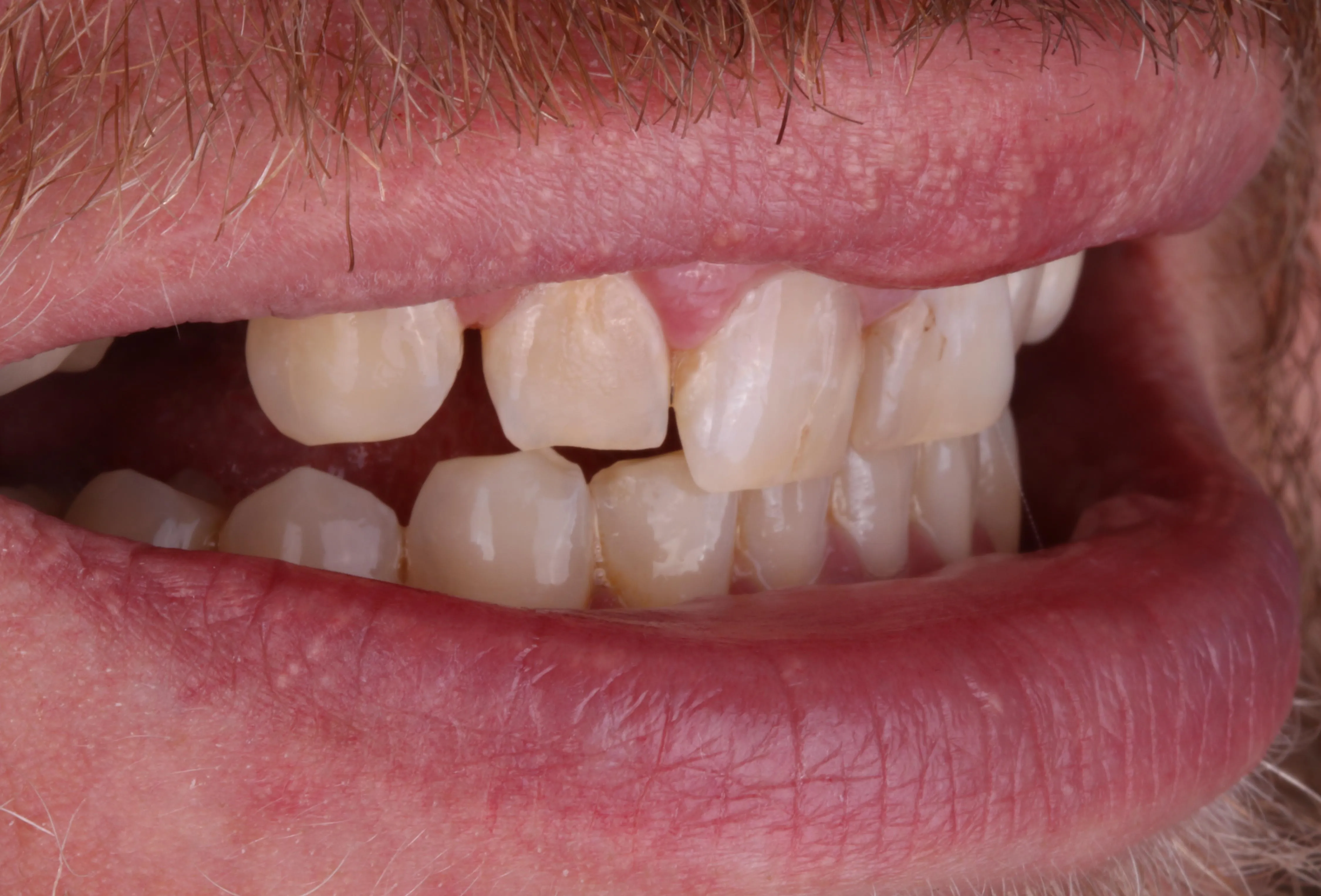 Przed wybielaniem – Side Dental Centre